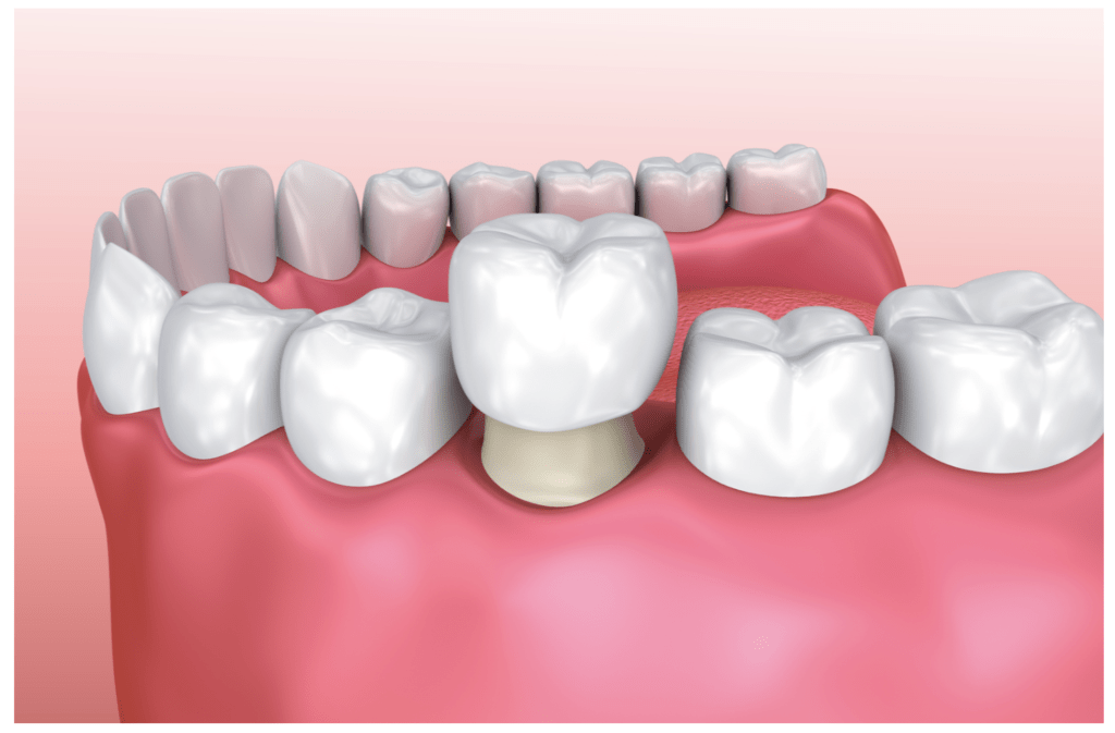 Comprehensive Guide to Crowns and Bridges