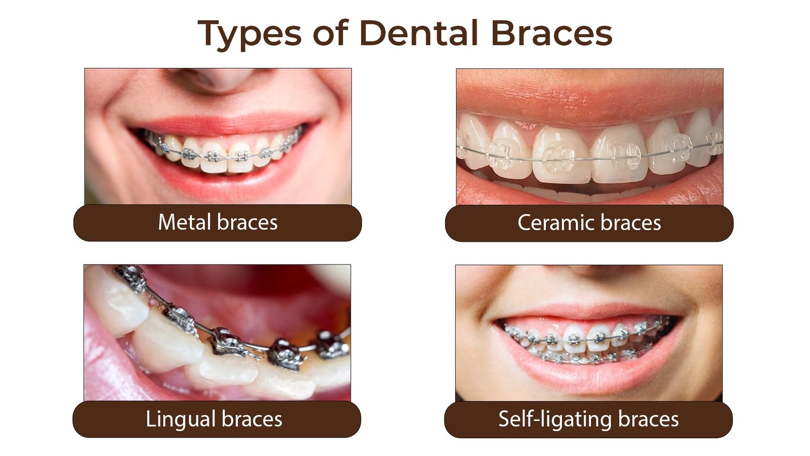 Dental Braces Types How They Work Smile Vizag Dental